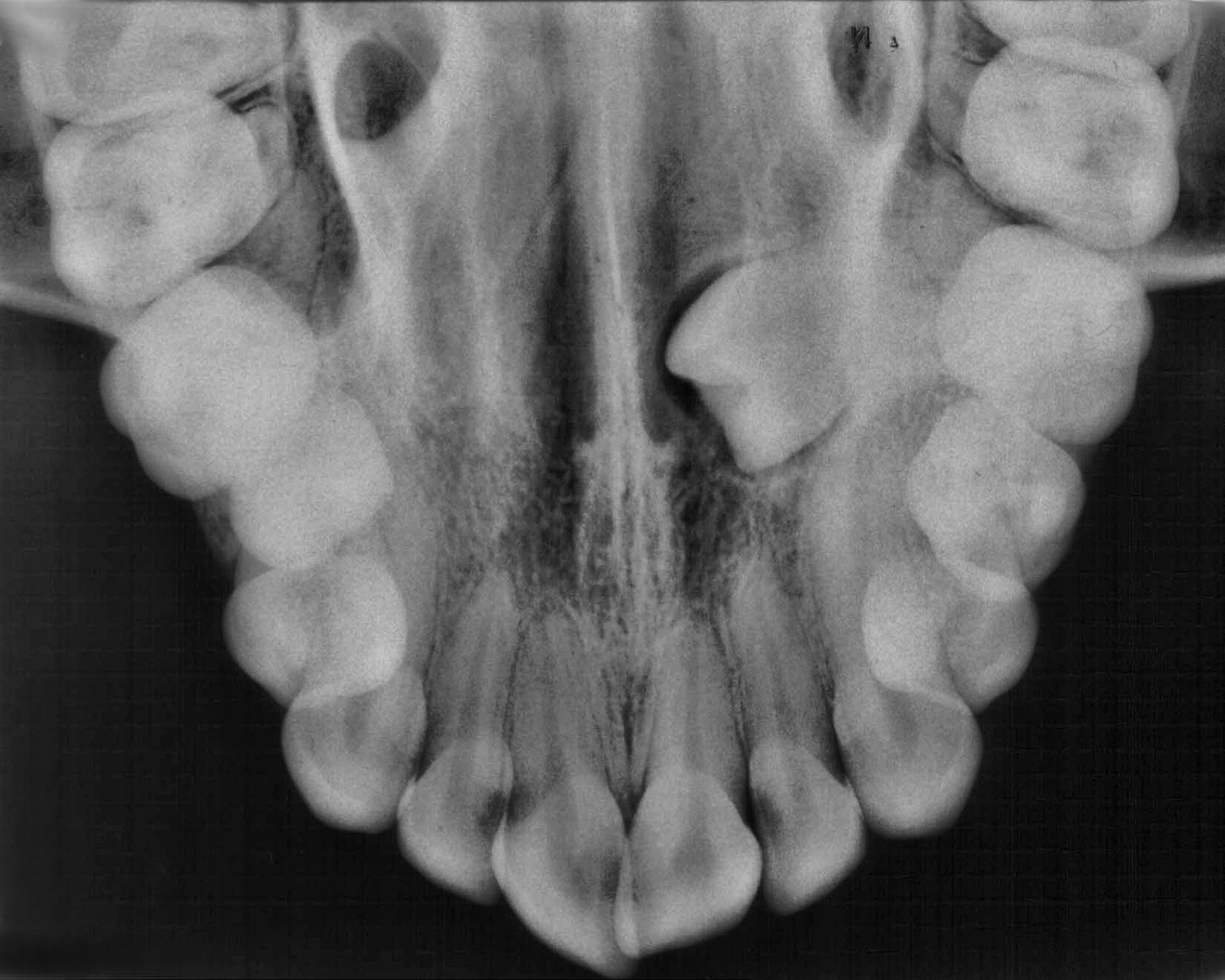 Oclusal maxila